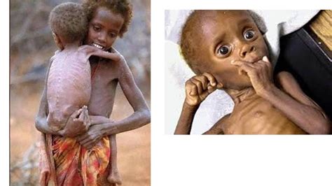 desnutrição infantil